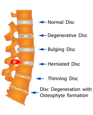 degenerative disc